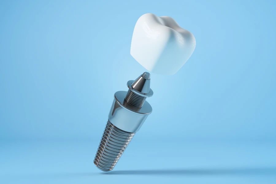 Ilustración de implante dental