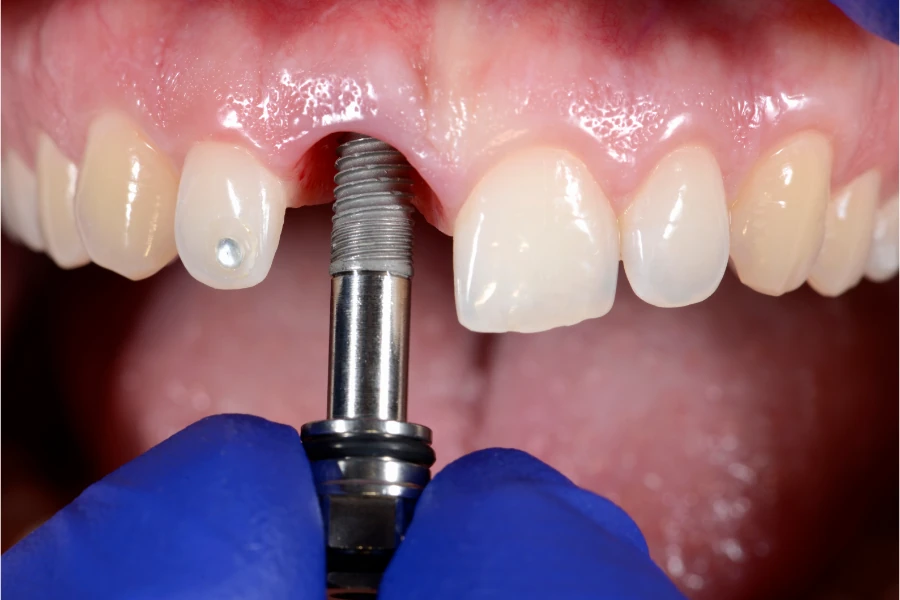 Implante dental realista